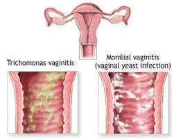 vaginitis