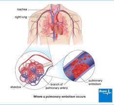 embolism