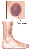 contusion