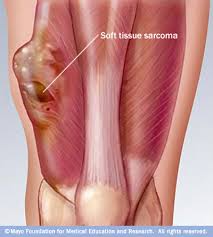 sarcoma