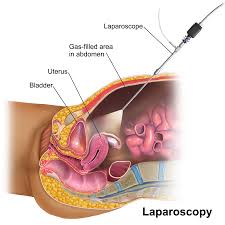 laparoscopy