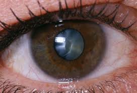 cataract