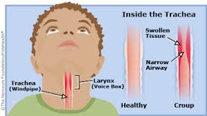 croup