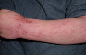 dermatitis