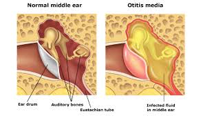 otitis