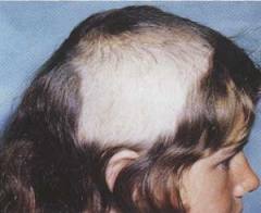 trichotillomania