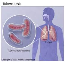 tuberculosis