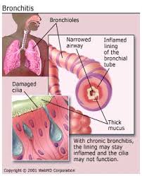 bronchitis