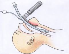 intubate