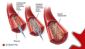 stent