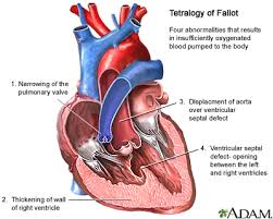 tetralogy