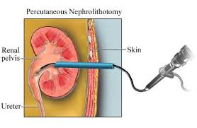 percutaneous