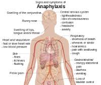 anaphylaxis