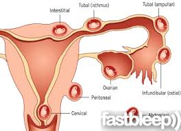 ectopic