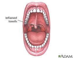 tonsillectomy