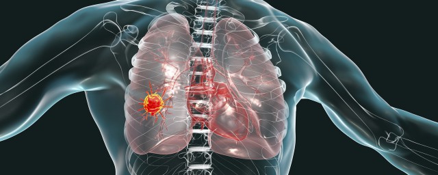 右上肺腺癌可以治好嗎 肺腺癌能徹底治愈嗎