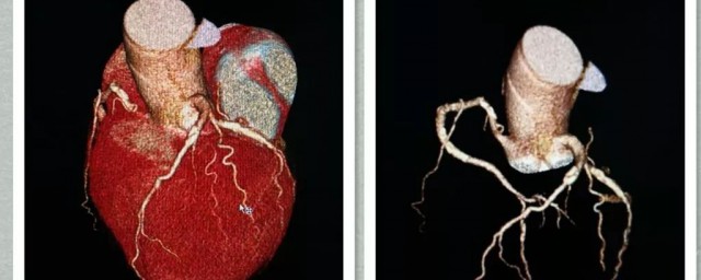 冠狀動脈ct的危害 檢查什麼的