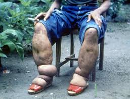 elephantiasis