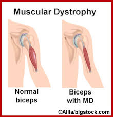 dystrophy