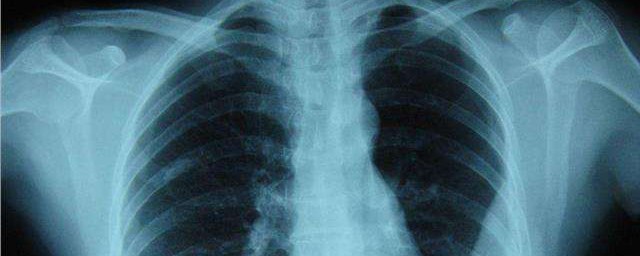 什麼是肺纖維鈣化 肺纖維鈣化屬於什麼病