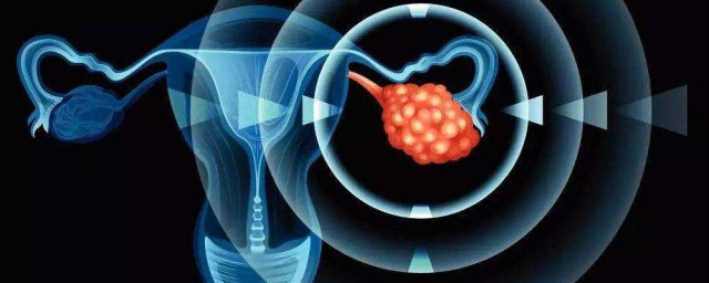 卵巢癌常見信號是什麼 5個信號是卵巢癌“報到”