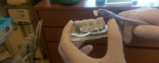 牙齒貼片的缺點危害 你瞭解多少