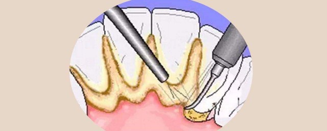 如何讓牙結石軟化脫落 牙齒上長瞭牙石怎樣清除掉