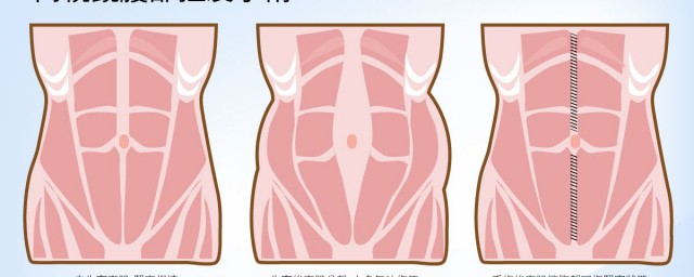 腹部抽脂對女性的危害 健康更重要