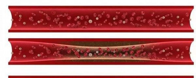 如何溶解血栓 什麼是血栓