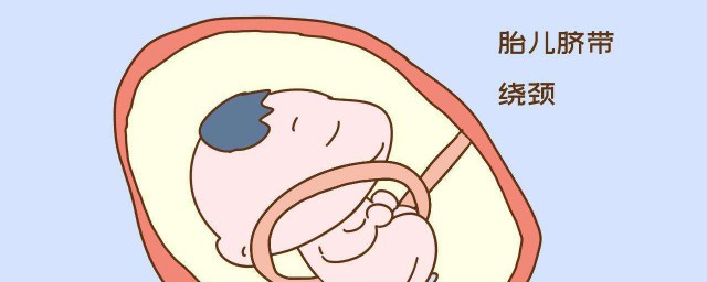 臍帶繞頸怎麼繞回來 胎寶寶頭朝上臍帶繞頸一周可以怎麼做讓他繞回來
