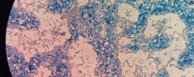 假絲酵母菌有哪些癥狀 外陰陰道假絲酵母菌病的臨床表現及診斷