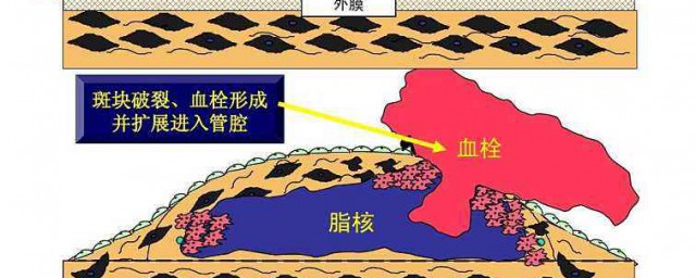 動脈粥樣硬化早期癥狀 動脈粥樣硬化的五個早期癥狀