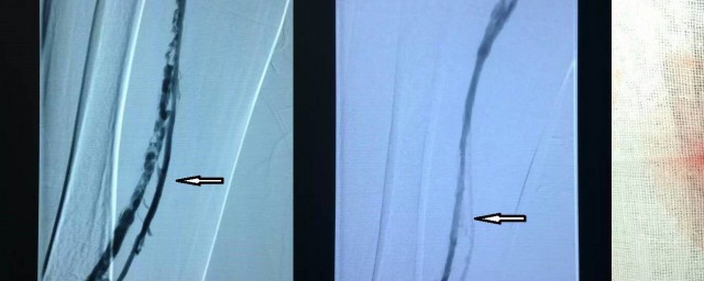 左腿血栓怎麼治療 腿上有血栓怎麼治療呢