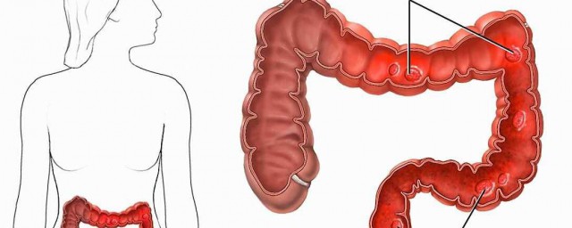 直腸癌的五大癥狀 直腸癌的表現